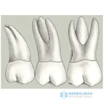Maxillary First and Second Molar